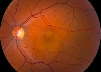 Corioretinopatia Sierosa Centrale