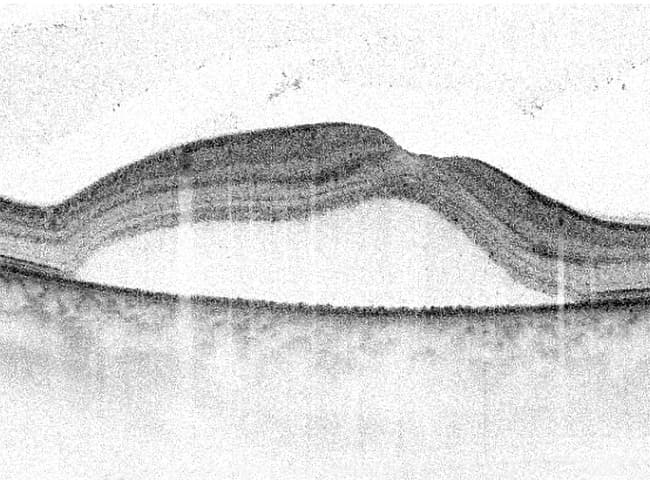 Corioretinopatia Sierosa Centrale