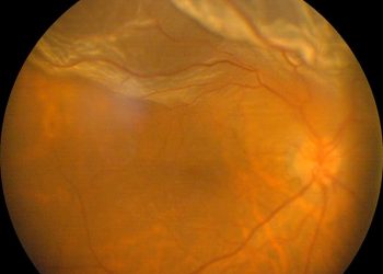 Distacco di Retina