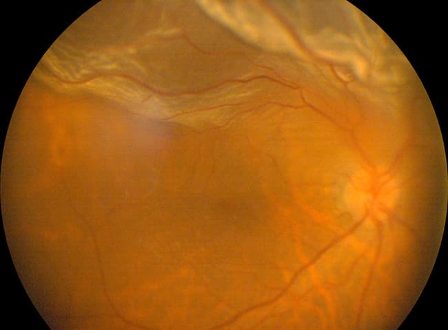 Distacco di Retina