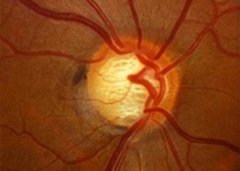 Glaucoma