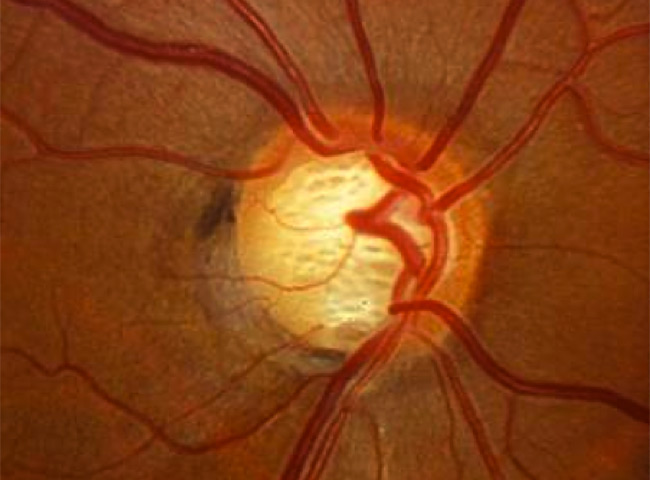 Glaucoma