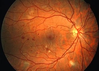 Retinopatia diabetica