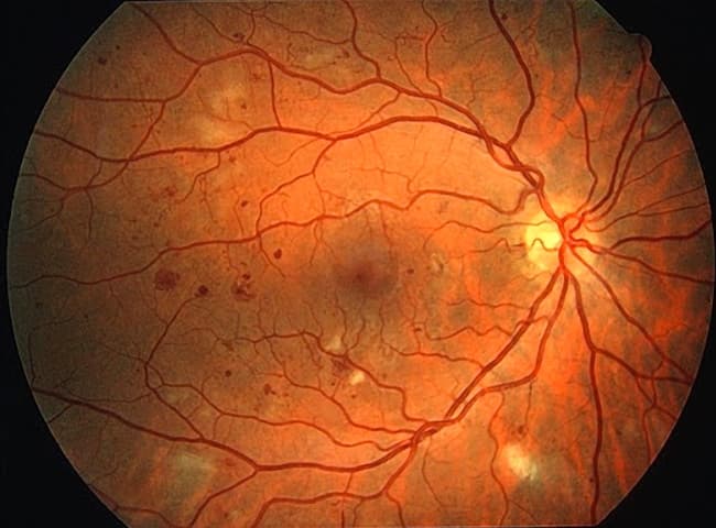 Retinopatia diabetica